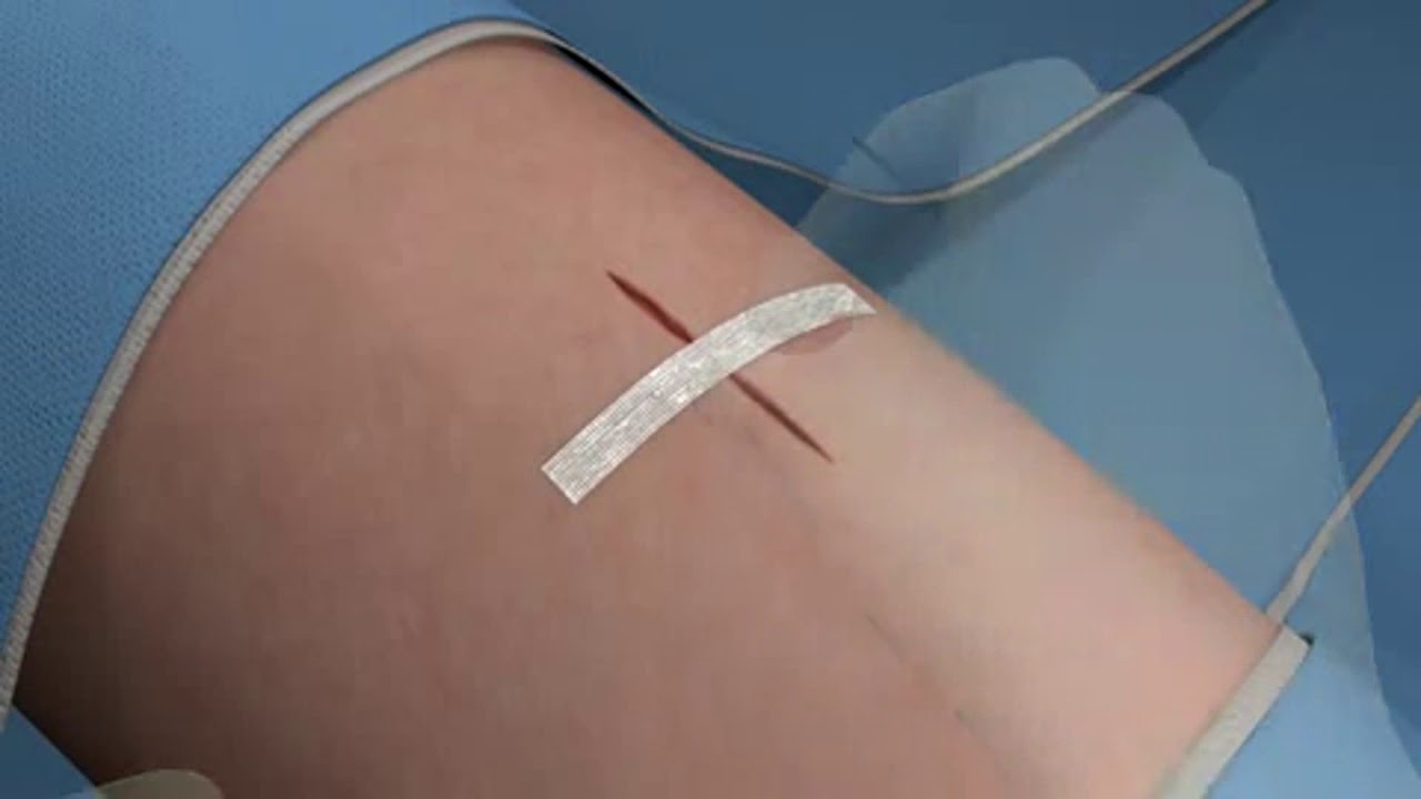 Bande de rapprochement ou suture cutanées adhésive Steri-Strip