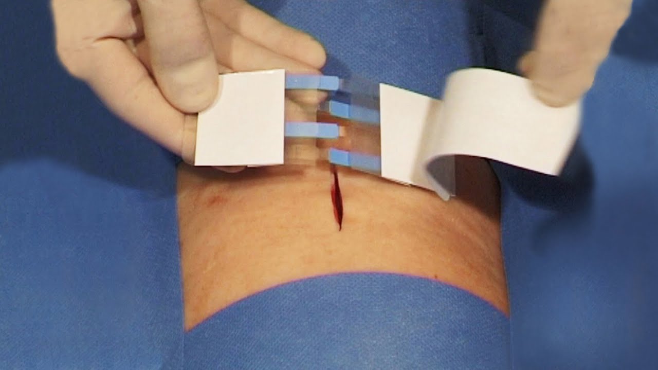 Bande de rapprochement ou suture cutanées adhésive Steri-Strip