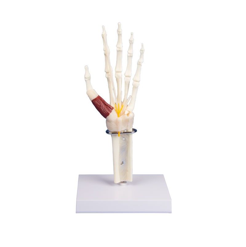 Anatomical model - Hand and wrist with carpal tunnel syndrome