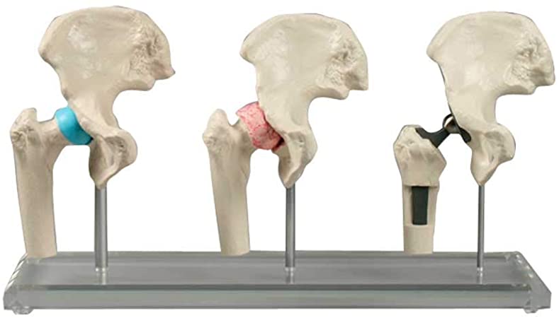 Ensemble de trois (3) modèles de hanche